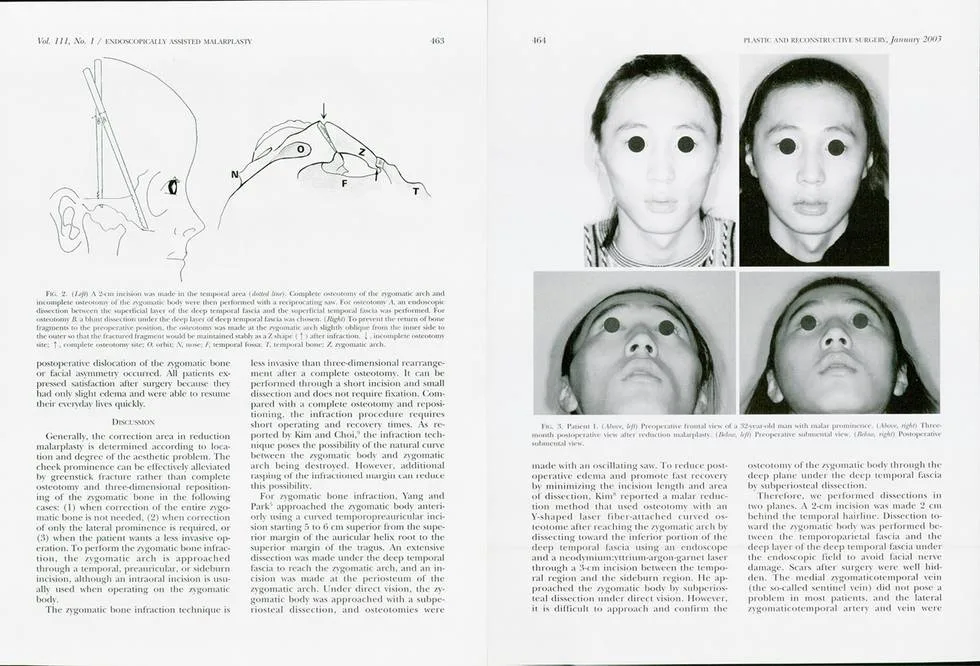 Zygoma reduction using the L-rotation technique — source material