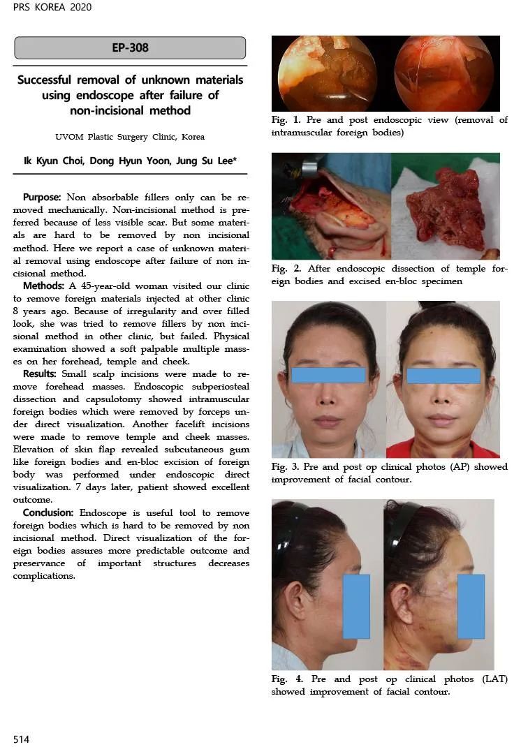 Endoscopic removal of foreign material after unsuccessful removal without an incision — source material