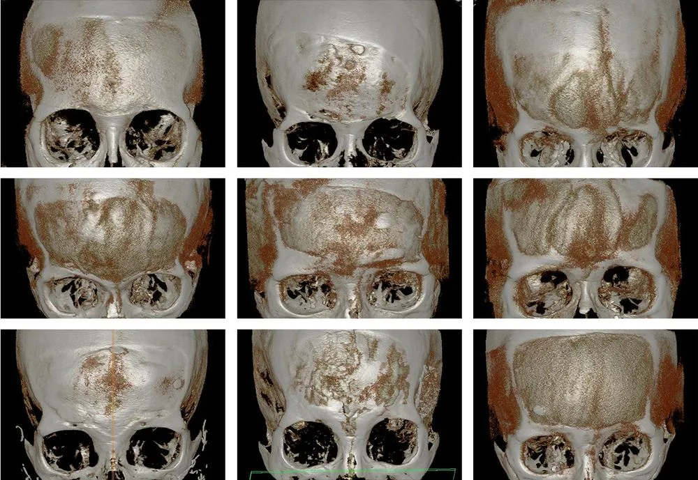 3D CT of a forehead implant