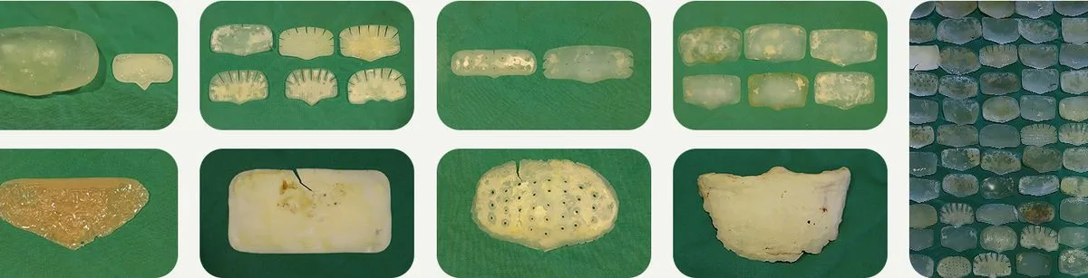 Various forehead implants removed at UVOM Plastic Surgery