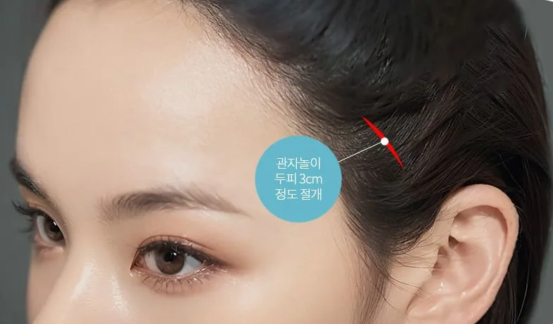 Location of the 3 cm temporal scalp incision