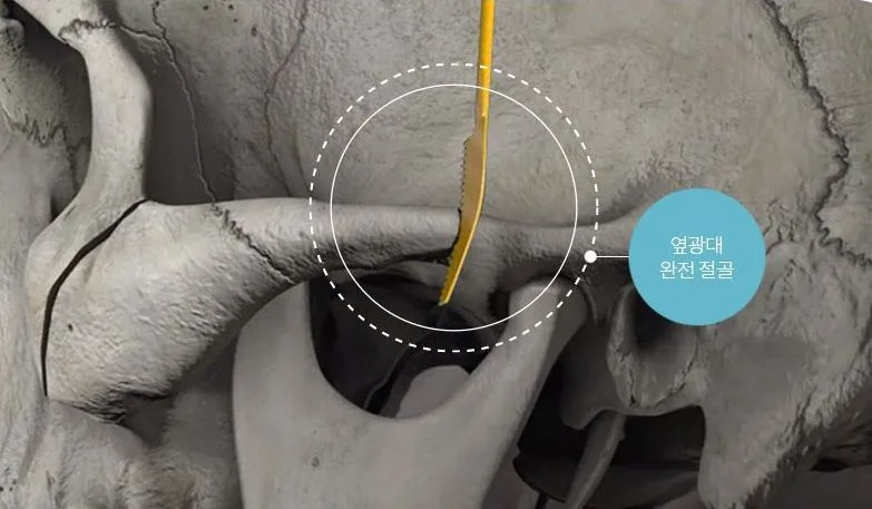 Complete osteotomy of the lateral cheekbone
