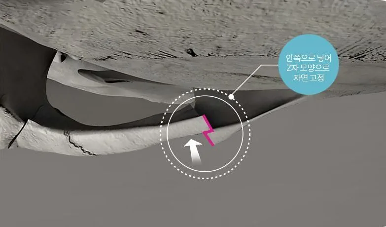 Inward repositioning with natural Z-shaped interlocking stability