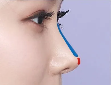 Diagram of an implant visible through the skin