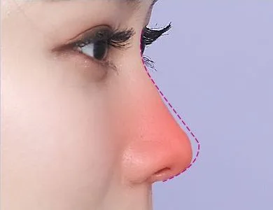 Diagram of a deformed nasal tip