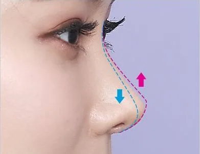 Diagram of a nasal bridge that is too low or too high