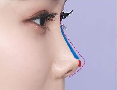 Diagram of a nose shortened by contracture
