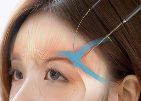 Image from materials related to Dr. Jung Su Lee, Chief Director of UVOM Plastic Surgery